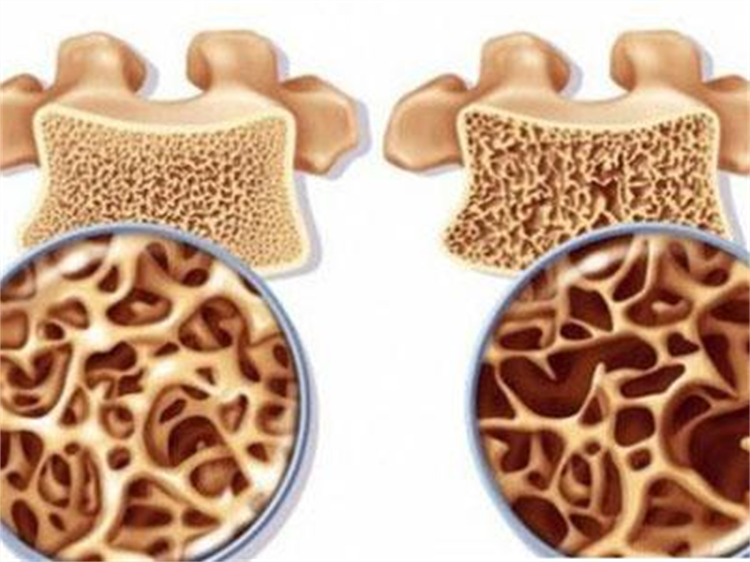 骨質(zhì)疏松癥，你真的了解嗎？
